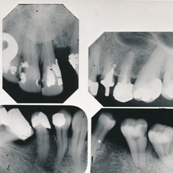 From Collection of Black and White Photographs of Dental Specimens (Rocs 8/3)