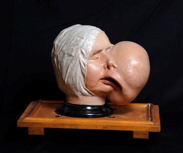 Plaster Model of the Head and Face Showing Deformity Produced by a Large Fibroma of the Left, 1837. Surgeons’ Hall Museums, RCSEd